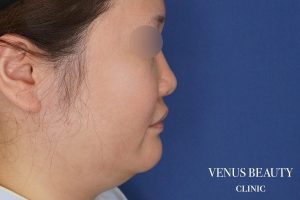 糸リフト+脂肪吸引 施術前