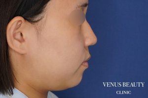 糸リフト+脂肪吸引 施術前