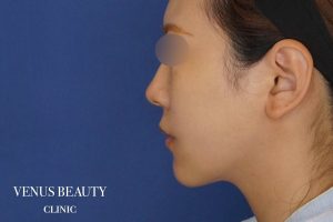 糸リフト+脂肪吸引 施術後