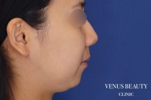 糸リフト+脂肪吸引 施術前