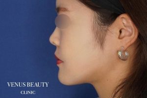 糸リフト+脂肪吸引 施術後