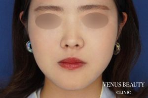 糸リフト+脂肪吸引 施術後