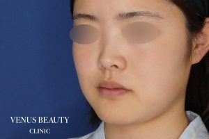 糸リフト+脂肪吸引 施術前