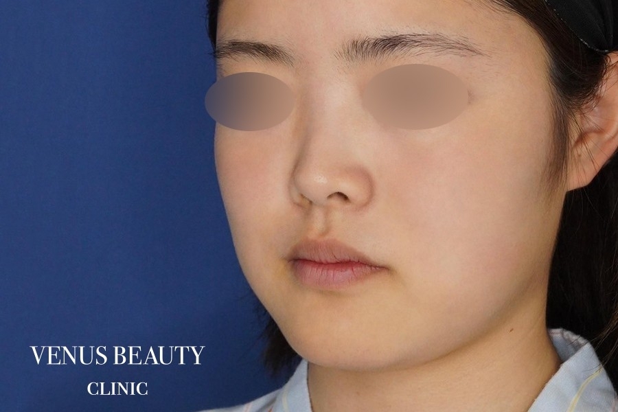 糸リフト＋脂肪吸引 施術前