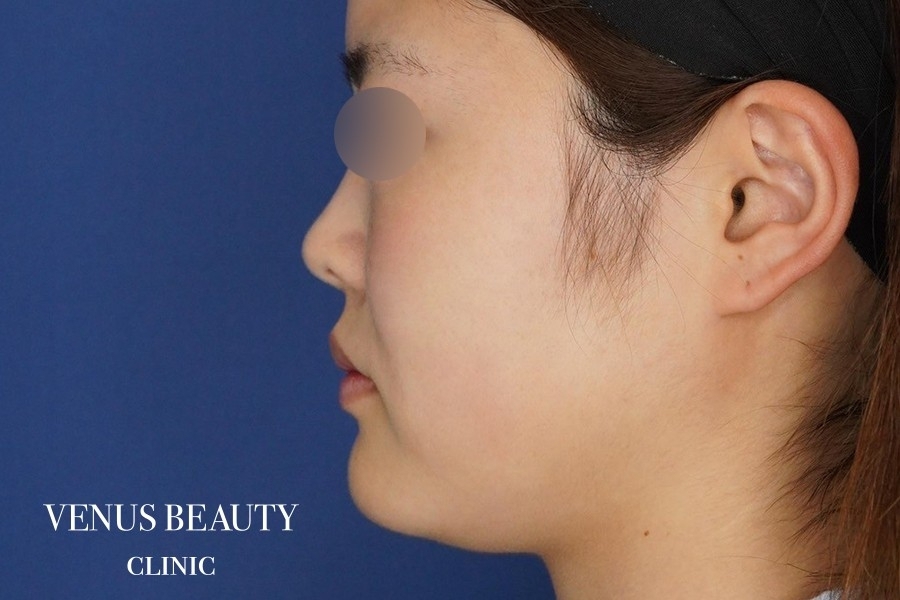 糸リフト＋脂肪吸引 施術前