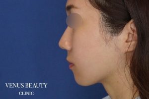 糸リフト+脂肪吸引 施術後