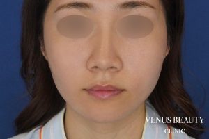 糸リフト+脂肪吸引 施術後