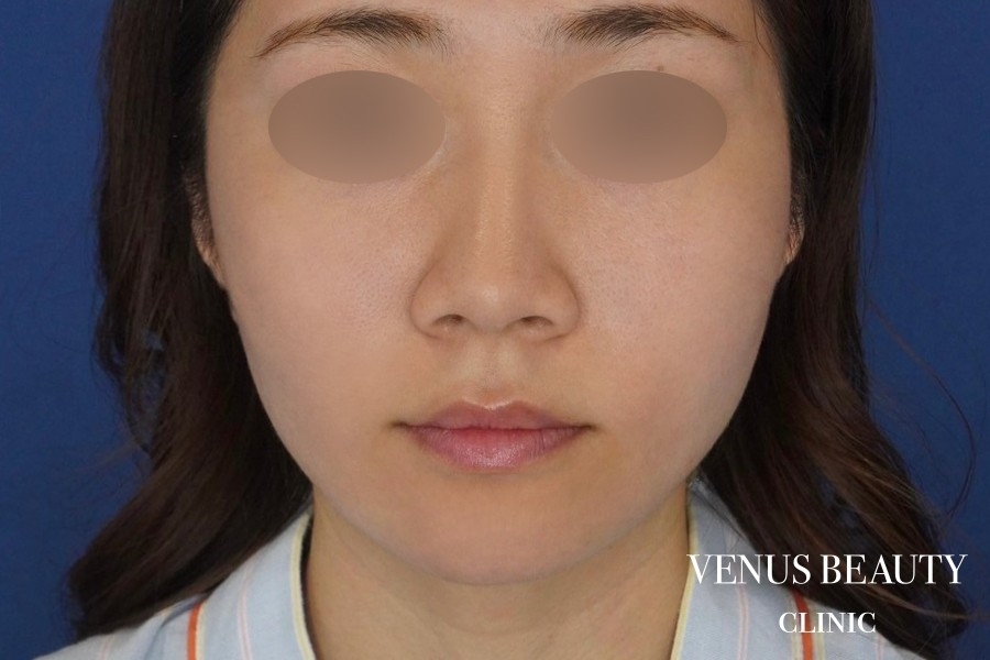 糸リフト＋脂肪吸引 施術後