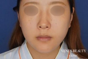 糸リフト+脂肪吸引 施術後