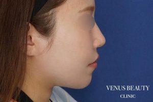 糸リフト+脂肪吸引 施術後