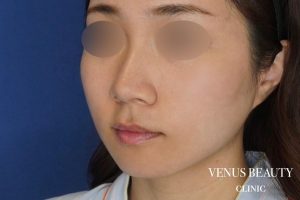 糸リフト+脂肪吸引 施術後