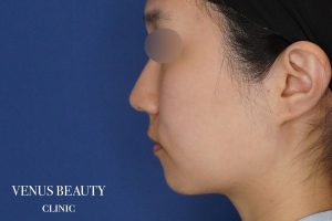 糸リフト+脂肪吸引 施術前