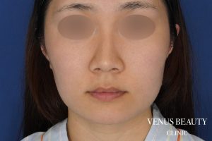 糸リフト+脂肪吸引 施術前