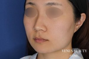 糸リフト+脂肪吸引 施術前