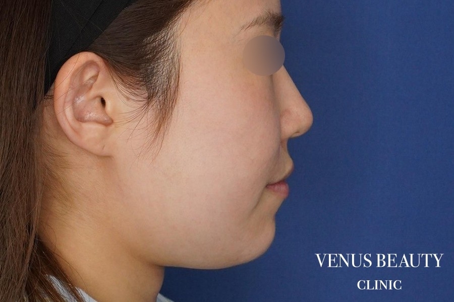 糸リフト＋脂肪吸引 施術前