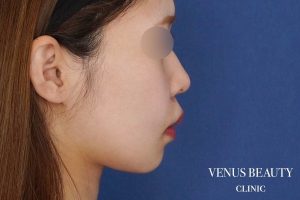 糸リフト+脂肪吸引 施術後