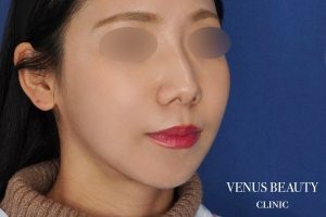 糸リフト+脂肪吸引 施術後