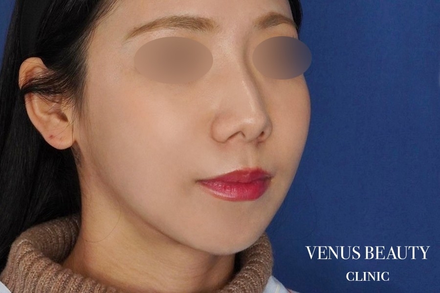 糸リフト＋脂肪吸引 施術後