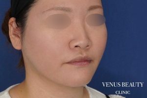 糸リフト+脂肪吸引 施術後