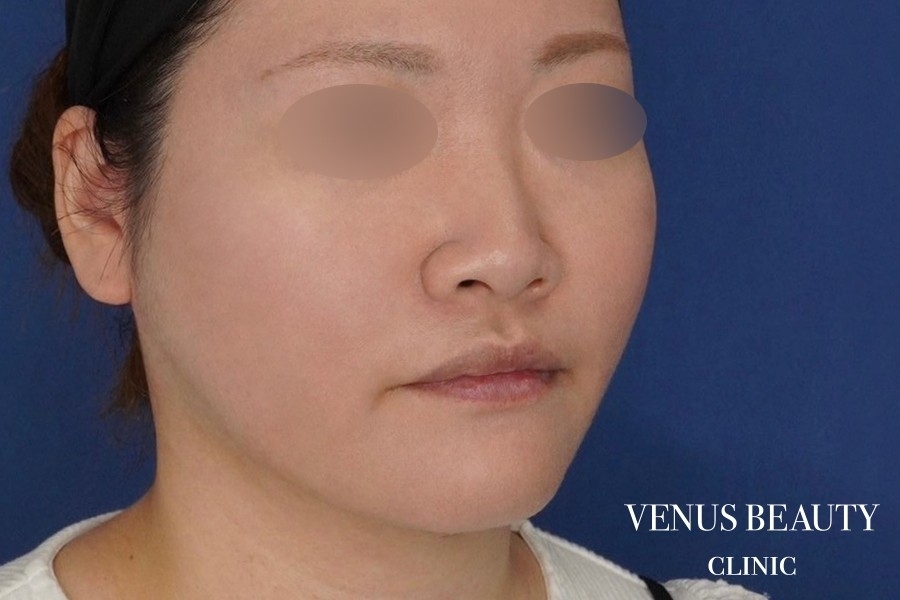 糸リフト＋脂肪吸引 施術後