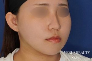 糸リフト+脂肪吸引 施術後