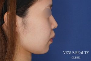 糸リフト+脂肪吸引 施術前