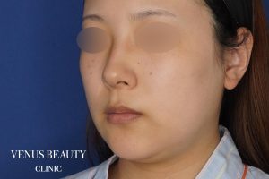 糸リフト+脂肪吸引 施術前