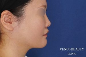 糸リフト+脂肪吸引 施術後