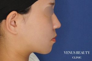 糸リフト+脂肪吸引 施術後