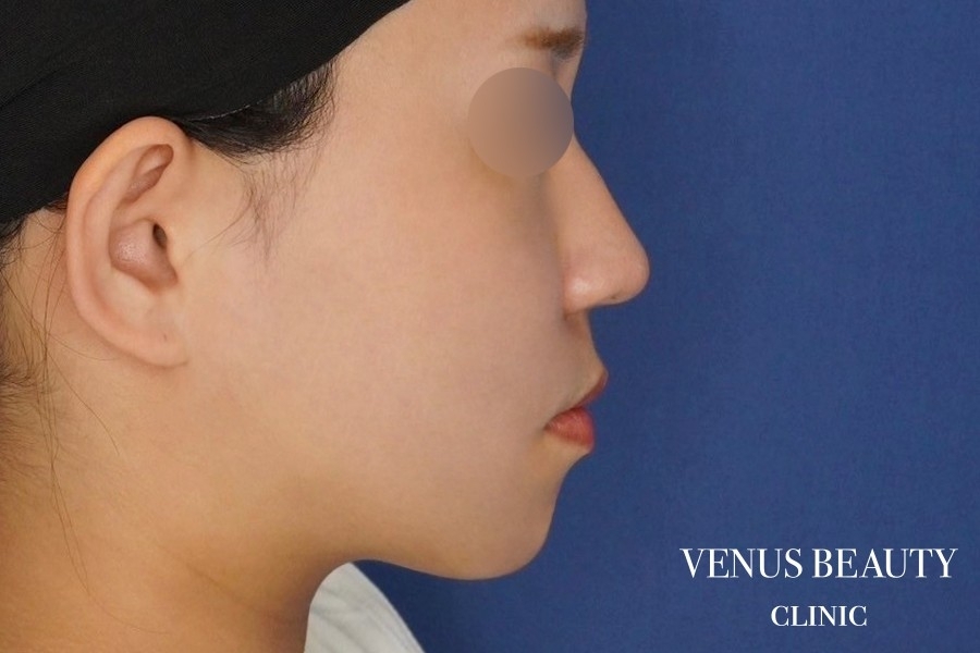 糸リフト＋脂肪吸引 施術後