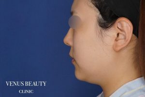 糸リフト+脂肪吸引 施術前