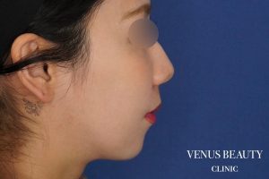糸リフト+脂肪吸引 施術後