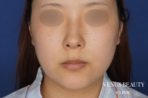 糸リフト+脂肪吸引 施術前