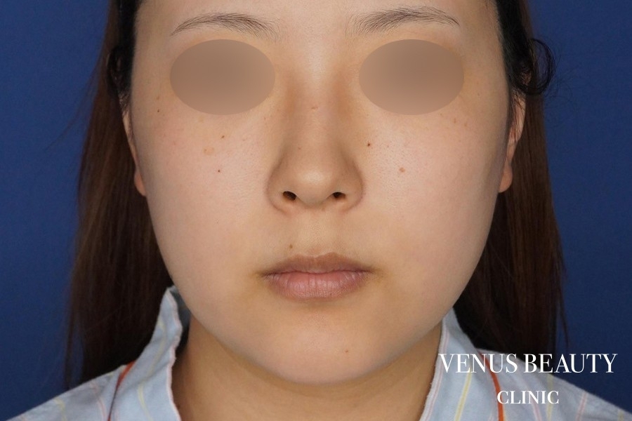 糸リフト＋脂肪吸引 施術前