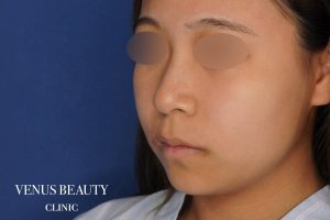 糸リフト+脂肪吸引 施術前