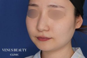 糸リフト+脂肪吸引 施術前