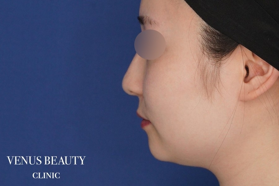 糸リフト＋脂肪吸引 施術前