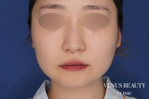 糸リフト+脂肪吸引 施術前