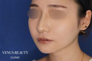 糸リフト+脂肪吸引 施術後