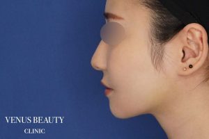 糸リフト+脂肪吸引 施術後