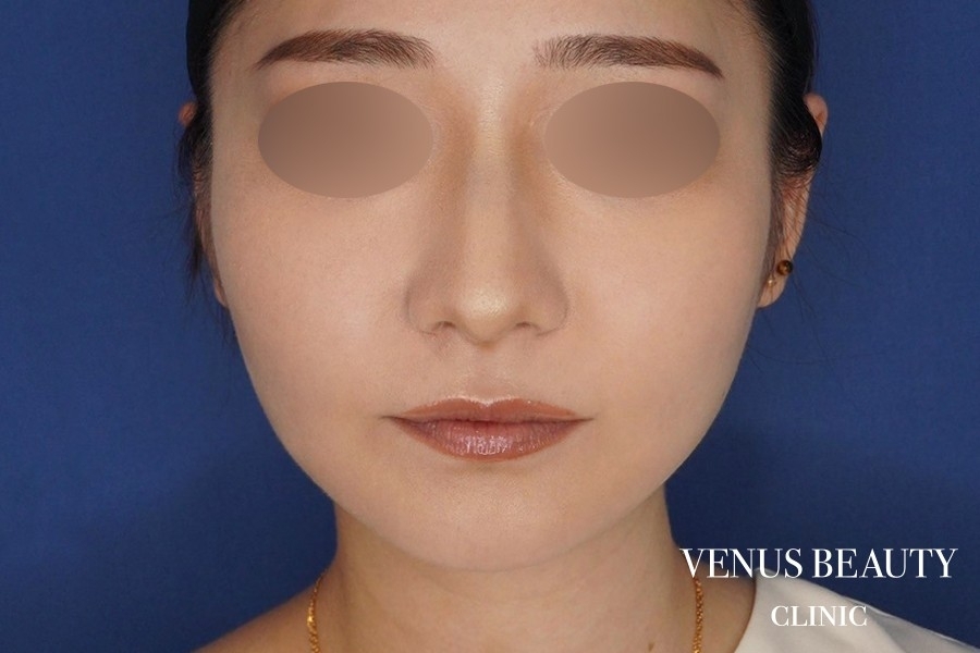 糸リフト＋脂肪吸引 施術後