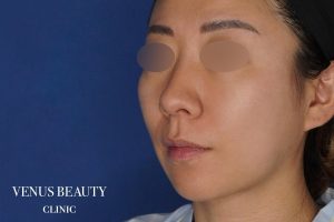 糸リフト+脂肪吸引 施術前