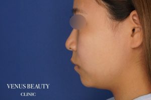 糸リフト+脂肪吸引 施術前