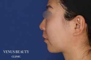 糸リフト+脂肪吸引 施術前