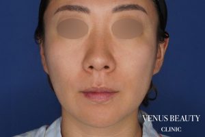 糸リフト+脂肪吸引 施術前