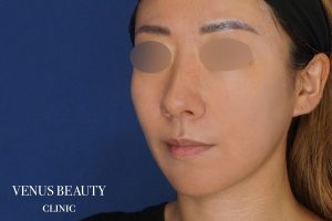 糸リフト+脂肪吸引 施術後