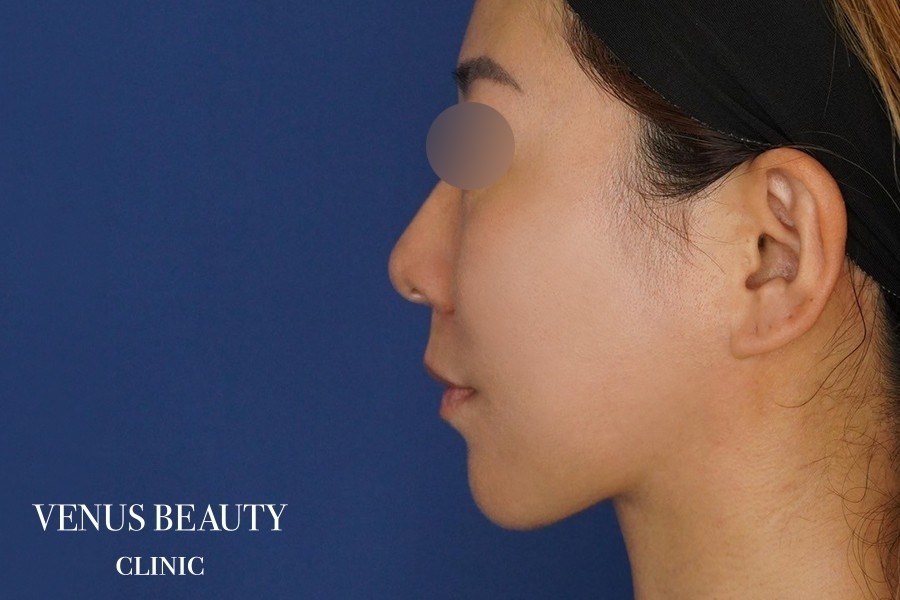 糸リフト＋脂肪吸引 施術後