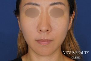 糸リフト+脂肪吸引 施術後