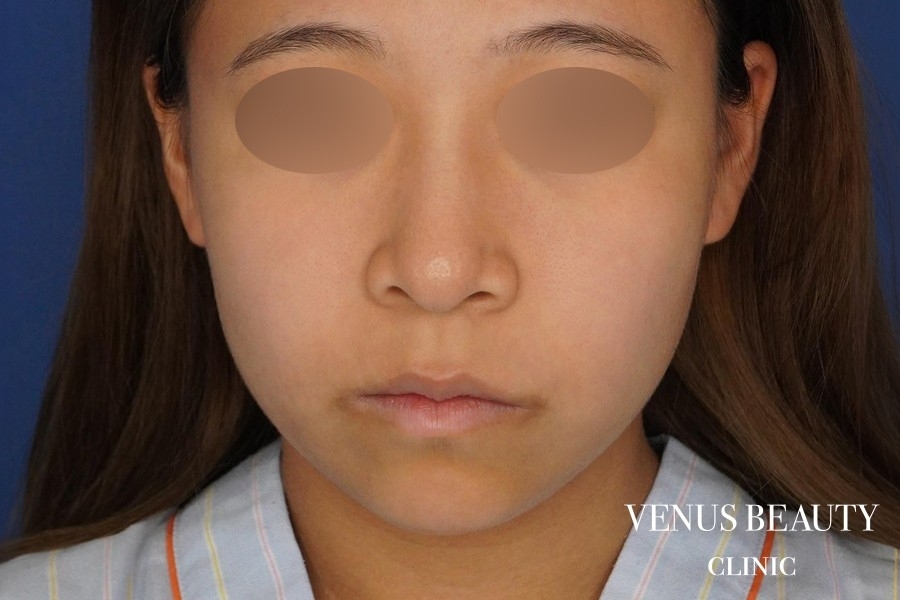 糸リフト＋脂肪吸引 施術前