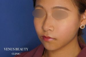 糸リフト+脂肪吸引 施術後